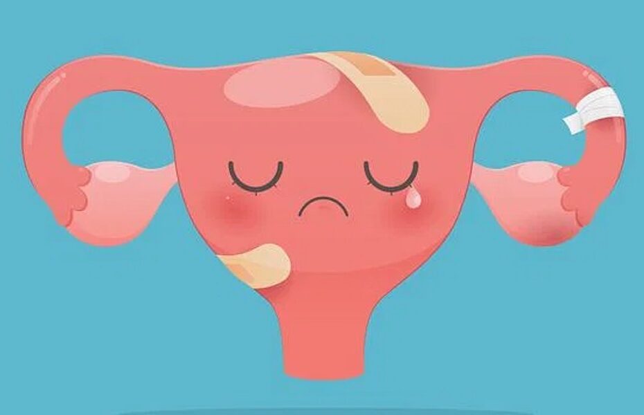 pcos symptoms quiz